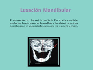 Es una rotación en el hueso de la mandíbula. Una luxación mandibular
significa que la parte inferior de la mandíbula se ha salido de su posición
normal en una o en ambas articulaciones donde está se conecta al cráneo.
 