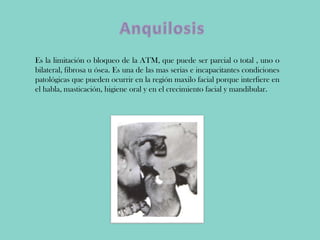 Es la limitación o bloqueo de la ATM, que puede ser parcial o total , uno o
bilateral, fibrosa u ósea. Es una de las mas serias e incapacitantes condiciones
patológicas que pueden ocurrir en la región maxilo facial porque interfiere en
el habla, masticación, higiene oral y en el crecimiento facial y mandibular.
 