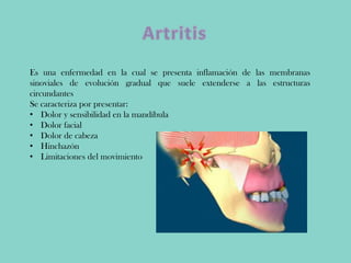 Es una enfermedad en la cual se presenta inflamación de las membranas
sinoviales de evolución gradual que suele extenderse a las estructuras
circundantes
Se caracteriza por presentar:
• Dolor y sensibilidad en la mandíbula
• Dolor facial
• Dolor de cabeza
• Hinchazón
• Limitaciones del movimiento
 