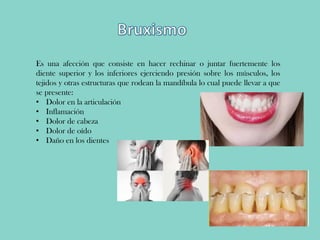 Es una afección que consiste en hacer rechinar o juntar fuertemente los
diente superior y los inferiores ejerciendo presión sobre los músculos, los
tejidos y otras estructuras que rodean la mandíbula lo cual puede llevar a que
se presente:
• Dolor en la articulación
• Inflamación
• Dolor de cabeza
• Dolor de oído
• Daño en los dientes
 