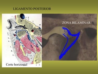 LIGAMENTO POSTERIOR
ZONA BILAMINAR
Corte horizontal
 