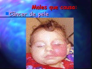 Males que causa: Câncer de pele . 