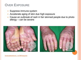 Hypoxemia Rash Atmospheric aerosols and air pollution, ozone | PPTX