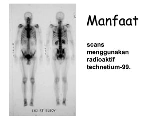 Manfaat
scans
menggunakan
radioaktif
technetium-99.
 