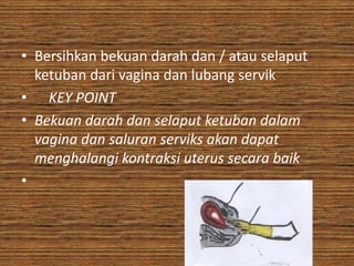 • Bersihkan bekuan darah dan / atau selaput
  ketuban dari vagina dan lubang servik
• KEY POINT
• Bekuan darah dan selaput ketuban dalam
  vagina dan saluran serviks akan dapat
  menghalangi kontraksi uterus secara baik
•
 
