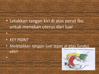 • Letakkan tangan kiri di atas perut ibu
  untuk menekan uterus dari luar
•
• KEY POINT
• Meletakkan tangan luar tepat di atas fundus
  uteri
•
 