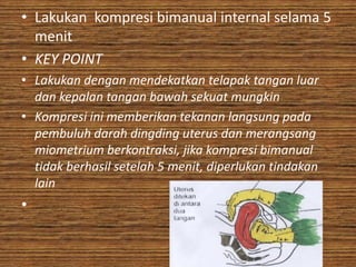 • Lakukan kompresi bimanual internal selama 5
  menit
• KEY POINT
• Lakukan dengan mendekatkan telapak tangan luar
  dan kepalan tangan bawah sekuat mungkin
• Kompresi ini memberikan tekanan langsung pada
  pembuluh darah dingding uterus dan merangsang
  miometrium berkontraksi, jika kompresi bimanual
  tidak berhasil setelah 5 menit, diperlukan tindakan
  lain
•
 