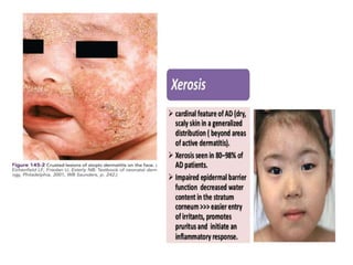 Atophic dermatitis Dr RAVINDRA G O | PPTX