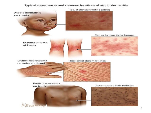 Atophic dermatitis Dr RAVINDRA G O | PPTX