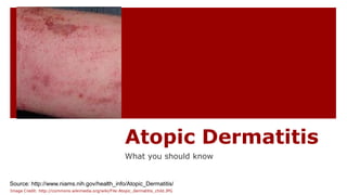 Atopic Dermatitis
What you should know
Source: http://www.niams.nih.gov/health_info/Atopic_Dermatitis/
Image Credit: http://commons.wikimedia.org/wiki/File:Atopic_dermatitis_child.JPG
 