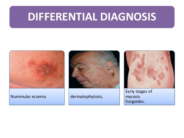 Atopic Dermatitis By Dr Gamal Soltan