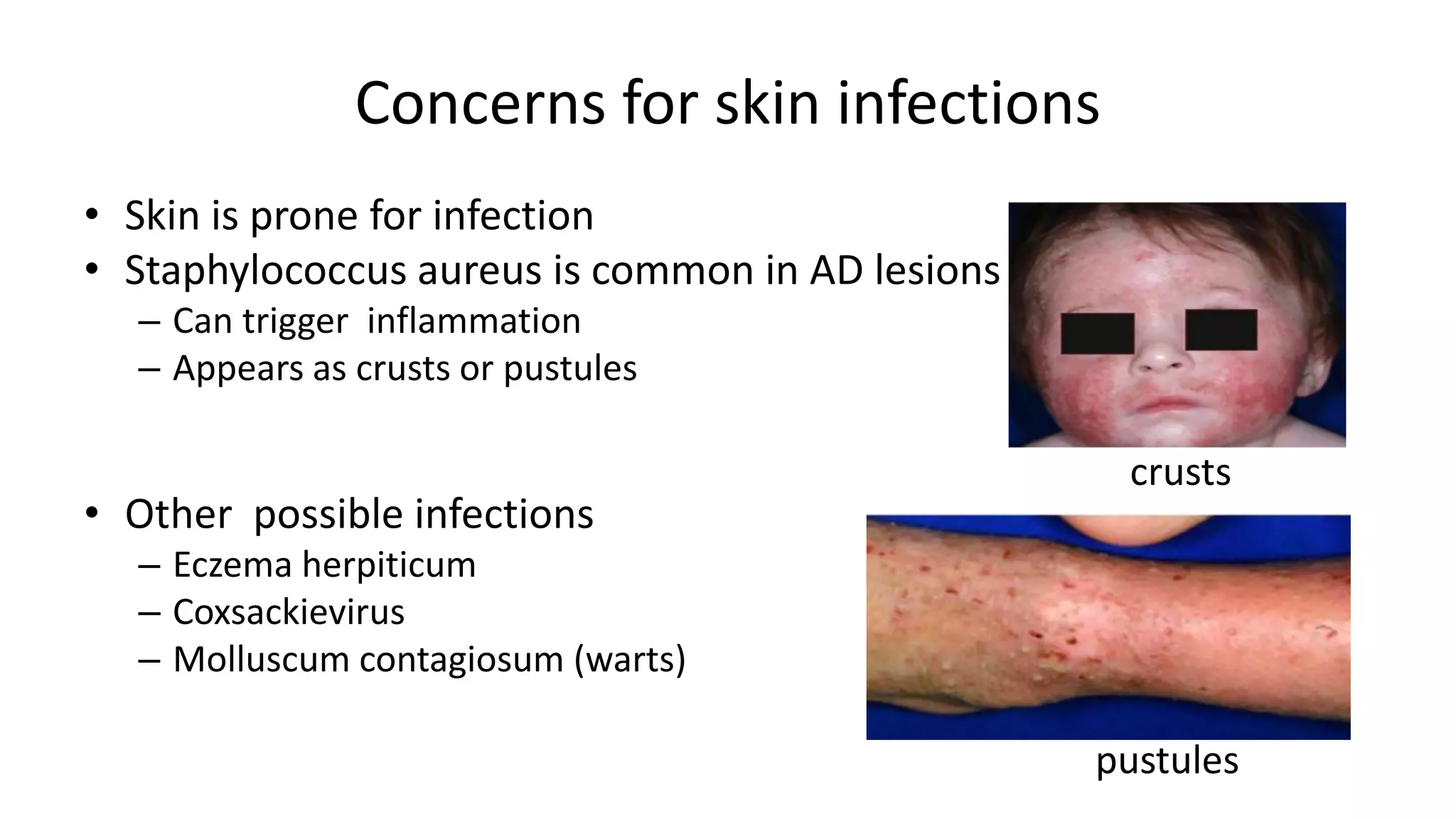 Atopic dermatitis | PPTX