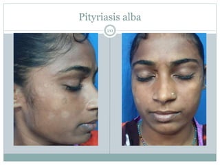 Pityriasis alba
20
 