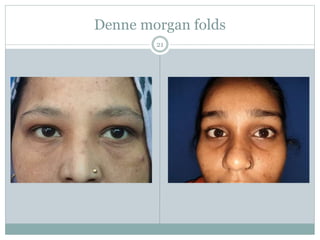 Denne morgan folds
21
 