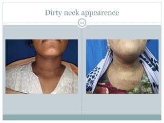 Dirty neck appearence
22
 