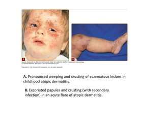 Atopic dermatis.pptx