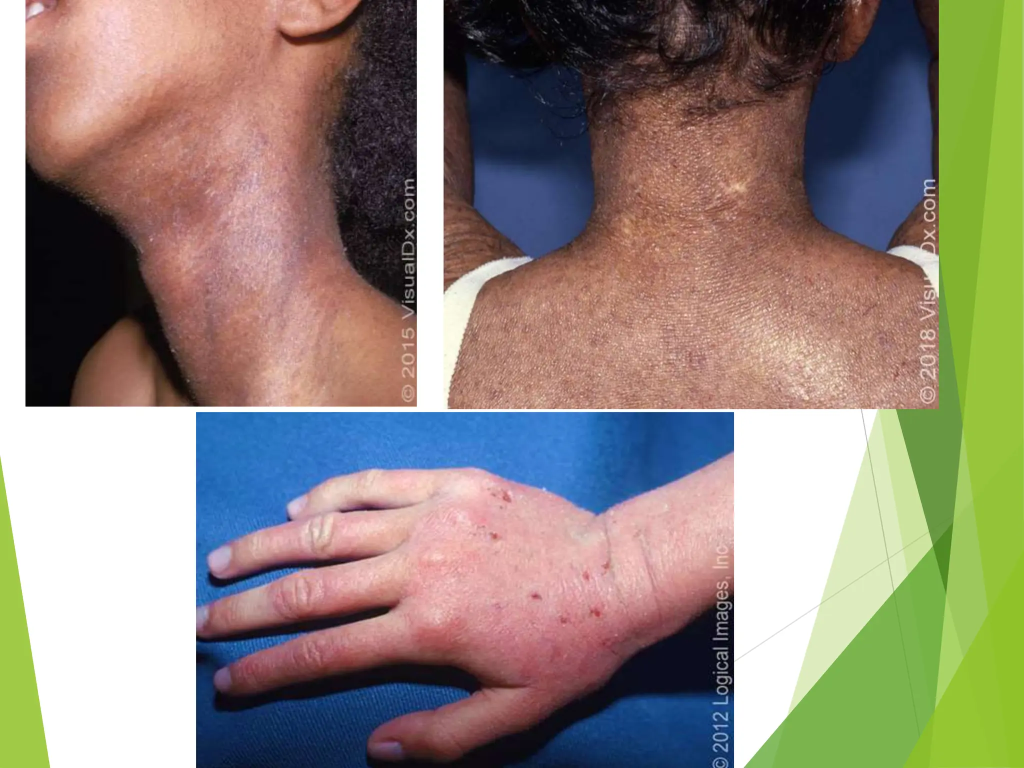 Atopic Dermatitis Atopic Dermatitis Atopic | PPT