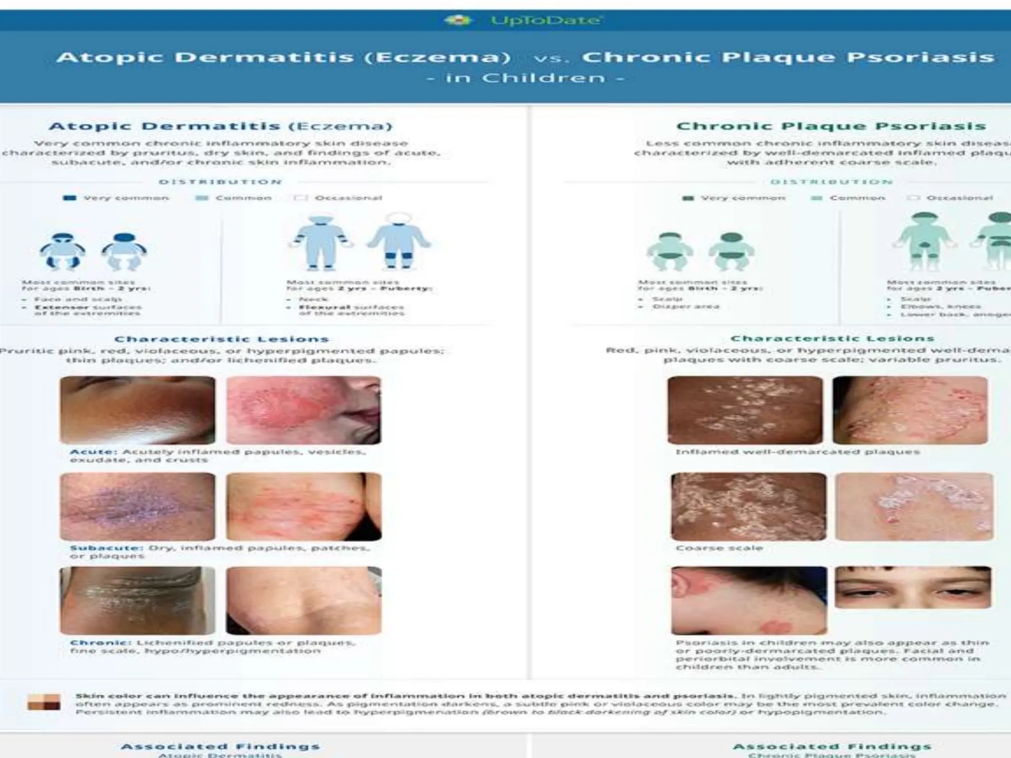 Dermatitis Classification Atopic Dermatitis Atopic Dermatitis Atopic | PPT