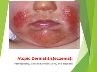 Atopic Dermatitis(eczema):
Pathogenesis, clinical manifestations, and diagnosis
 