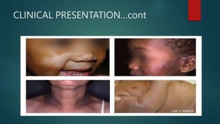 CLINICAL PRESENTATION…cont
 