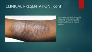 CLINICAL PRESENTATION…cont
Lichenificatioin: thickening and
whitening of the skin due to
scratching. Occurs in chronic
eczema.
 