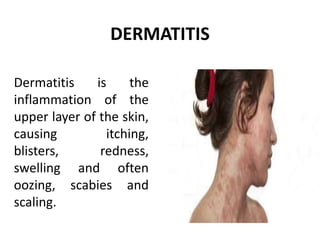 DERMATITIS
Dermatitis is the
inflammation of the
upper layer of the skin,
causing itching,
blisters, redness,
swelling and often
oozing, scabies and
scaling.
 