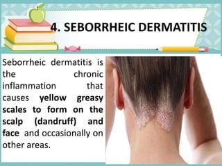 4. SEBORRHEIC DERMATITIS
Seborrheic dermatitis is
the chronic
inflammation that
causes yellow greasy
scales to form on the
scalp (dandruff) and
face and occasionally on
other areas.
 