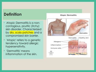 Atopic Definition Atopic_Dermatitis_Detailed_Presentation.pptx