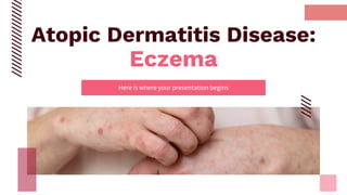 Atopic Dermatitis Disease:
Eczema
Here is where your presentation begins
 