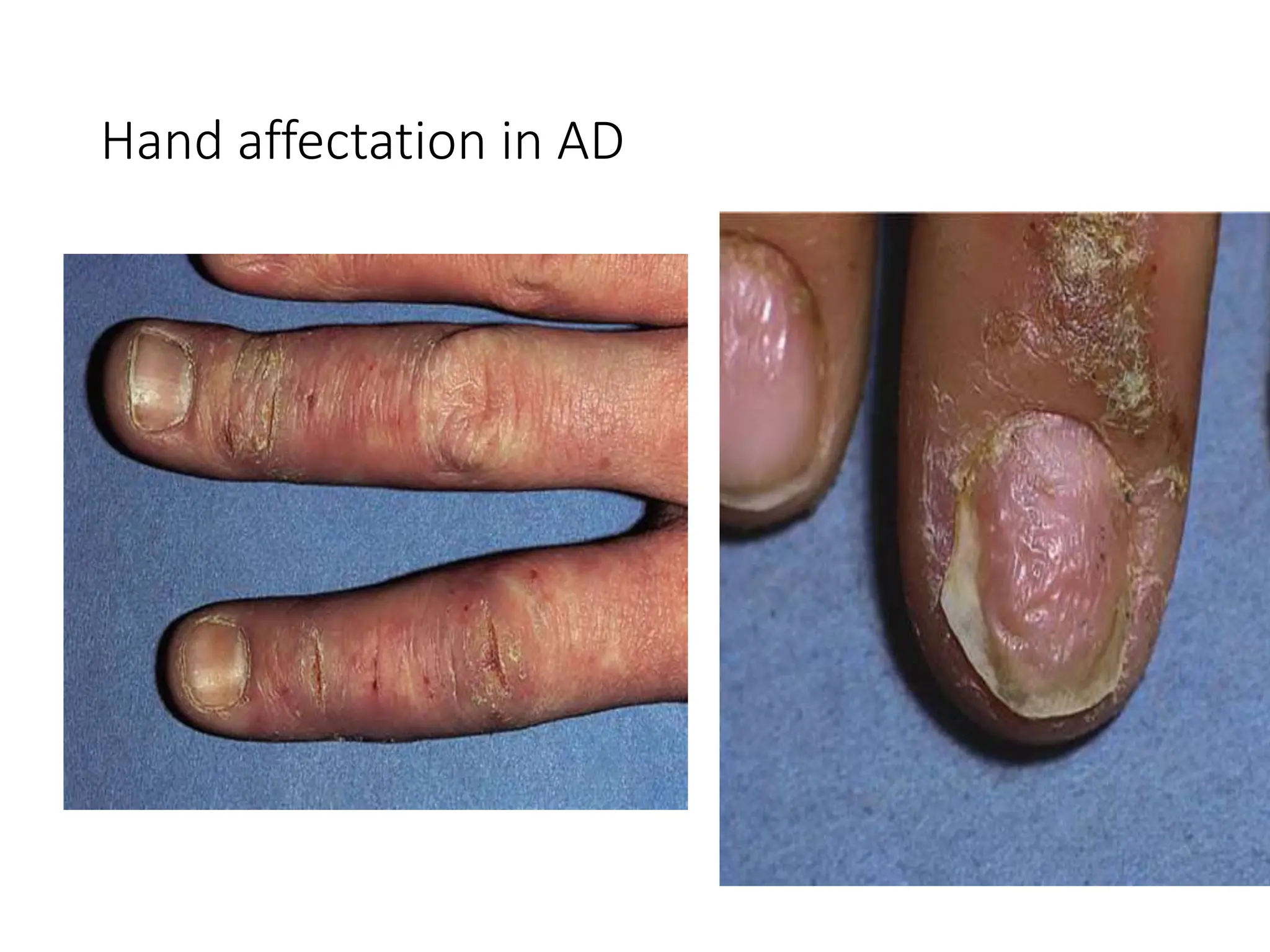Pathogenesis clinical features and management of Atopic dermatitis ...
