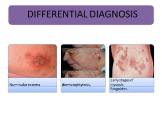 Scatteredl Distribution Rash Comprehensive Overview of Atopic Dermatitis: Pathophysiology, Clinical ...
