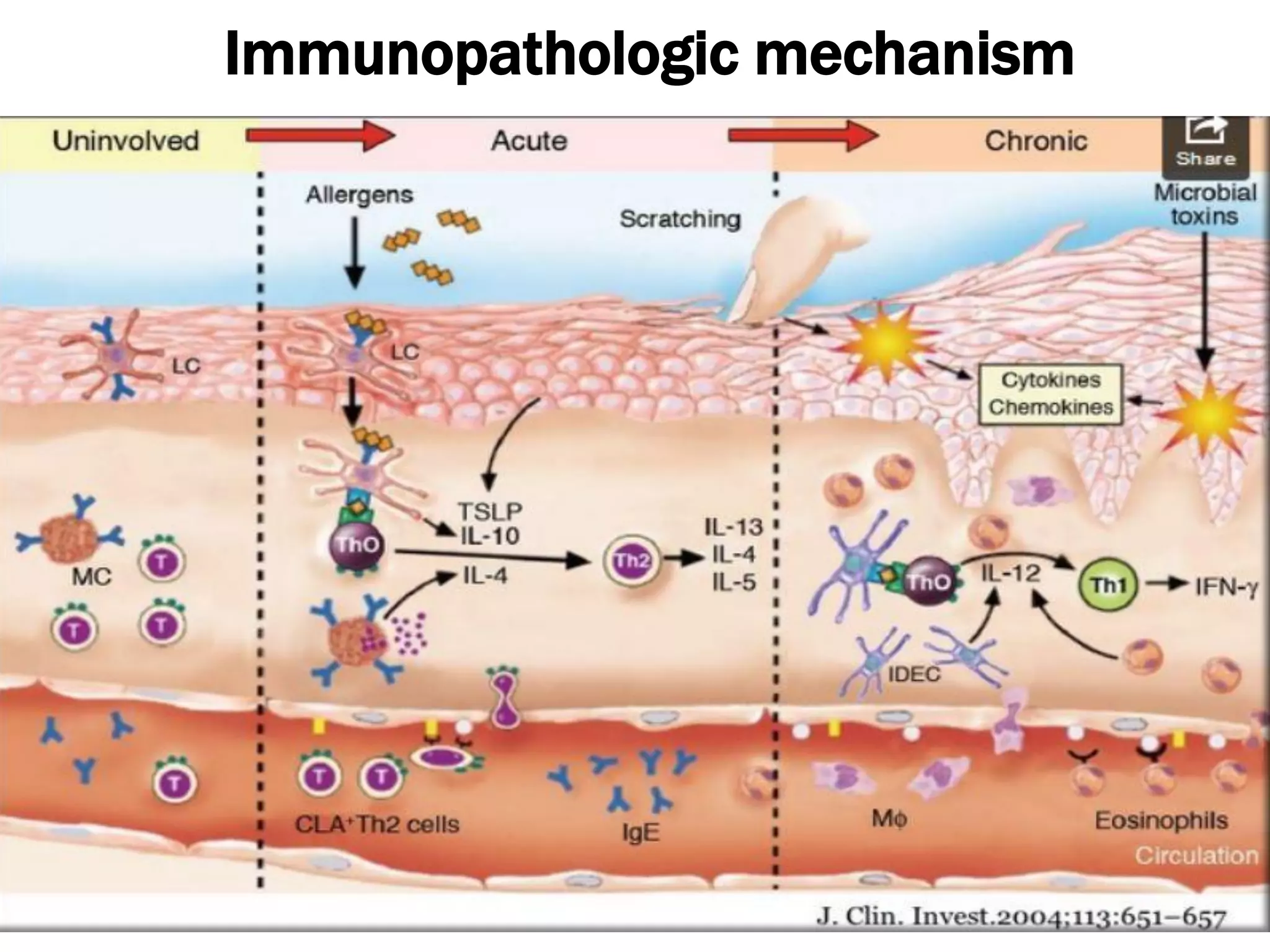 The pathogenesis of Atopic dermatitis | PPT