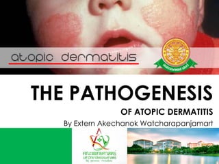 THE PATHOGENESIS
OF ATOPIC DERMATITIS
By Extern Akechanok Watcharapanjamart
 