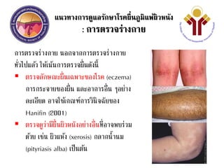 แนวทางการดูแลรักษาโรคผื่นภูมิแพ้ผิวหนัง
: การตรวจร่างกาย
การตรวจร่างกาย นอกจากการตรวจร่างกาย
ทั่วไปแล้ว ให้เน้นการตรวจผื่นดังนี้
 ตรวจลักษณะผื่นเฉพาะของโรค (eczema)
การกระจายของผื่น และอาการอื่น ๆอย่าง
ละเอียด อาจใช้เกณฑ์การวินิจฉัยของ
Hanifin (2001)
 ตรวจดูว่ามีผื่นผิวหนังอย่างอื่นที่อาจพบร่วม
ด้วย เช่น ผิวแห้ง (xerosis) กลากน้านม
(pityriasis alba) เป็นต้น
 