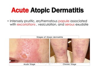 Acute Atopic Dermatitis
• Intensely pruritic, erythematous papule associated
with excoriations , vesiculation, and serous exudate
 
