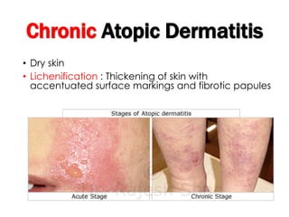 Chronic Atopic Dermatitis
• Dry skin
• Lichenification : Thickening of skin with
accentuated surface markings and fibrotic papules
 