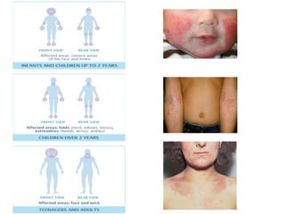 The pathogenesis of Atopic dermatitis 