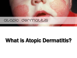 What is Atopic Dermatitis?
 