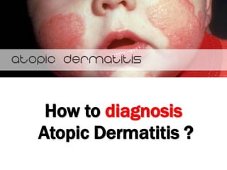 How to diagnosis
Atopic Dermatitis ?
 