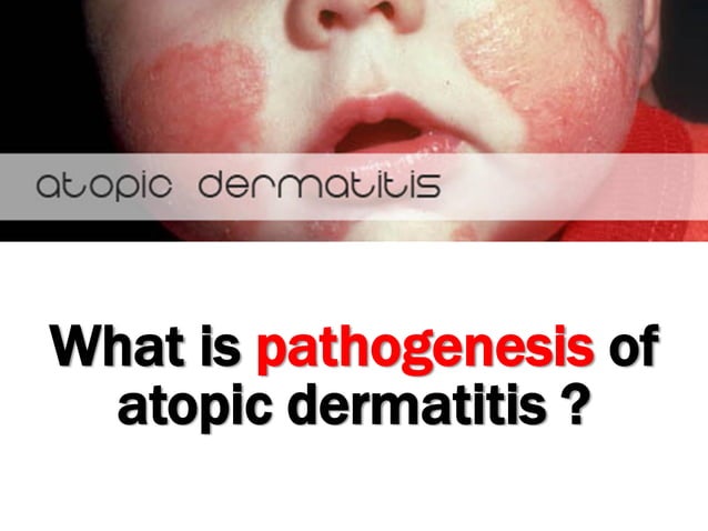 The pathogenesis of Atopic dermatitis