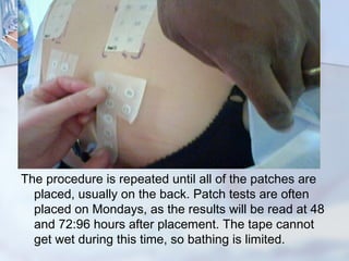 Atopy Panel Atopy patch test | PPT
