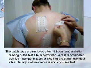 Atopy patch test | PPT