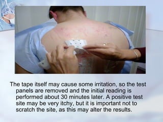 Atopy Panel Atopy patch test | PPT