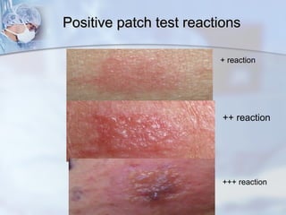 Atopy patch test | PPT
