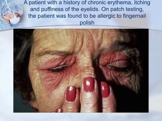 Atopy patch test | PPT
