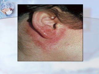 Atopy patch test | PPT