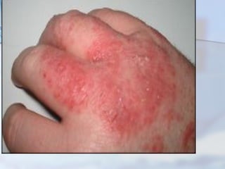 Atopy patch test | PPT