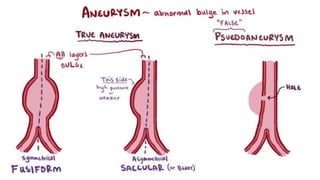 Aneurysms - Pathology - ATOT | PPTX