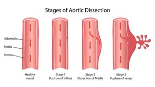 Aneurysms - Pathology - ATOT | PPTX