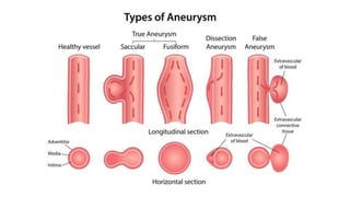 Aneurysms - Pathology - ATOT | PPTX